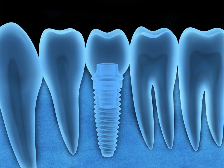 インプラント│dentaluck│デンタラック編集部厳選のおすすめ歯科医院